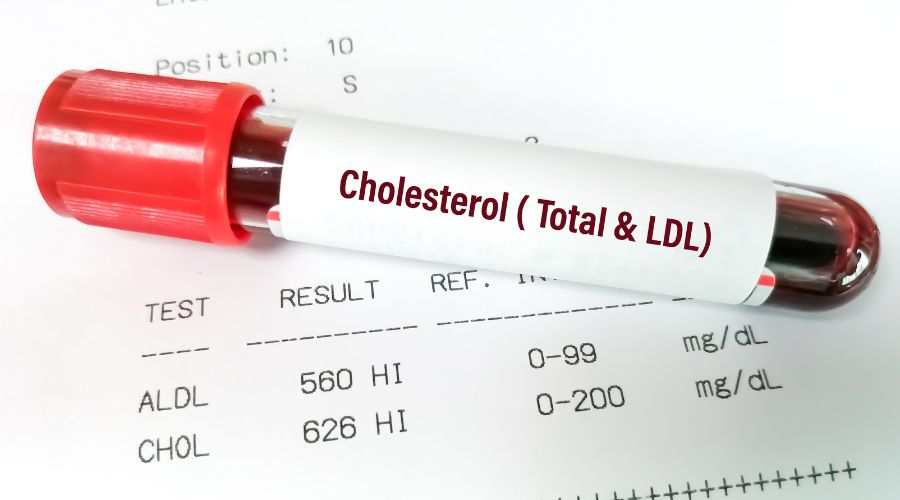 LDL cholesterol test