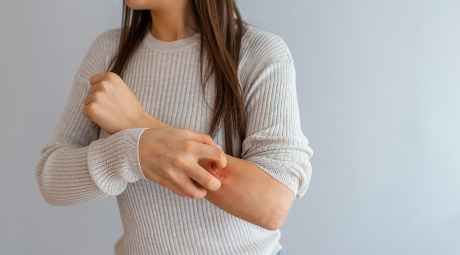 Skin rashes from food allergy